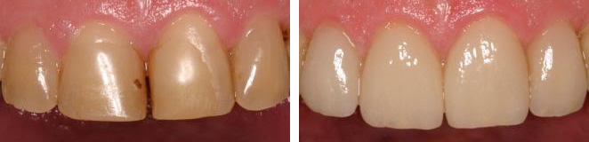 ba-cerec-1