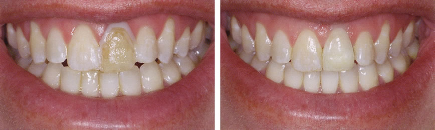 Porcelain Crowns Before After