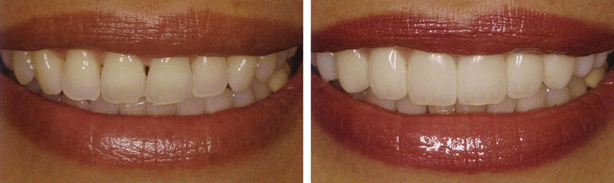 Veneers Before After
