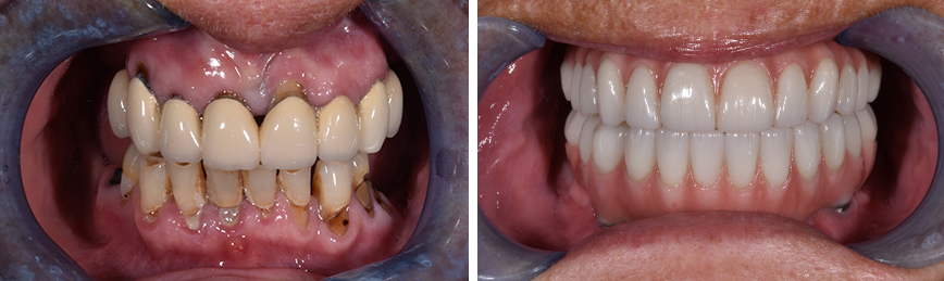Dental Implants Before After
