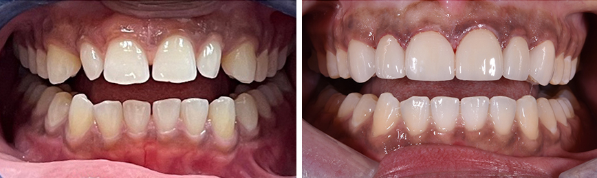 Veneers before/after