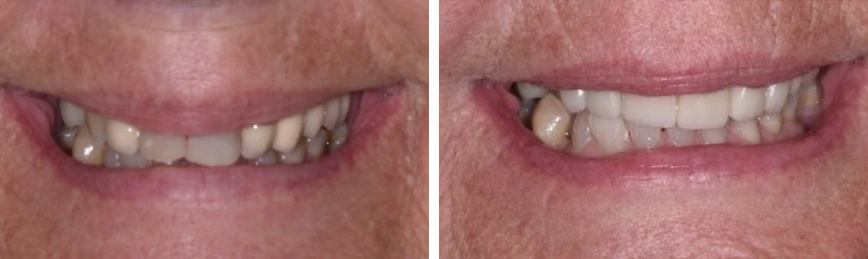 Porcelain Crowns Before After