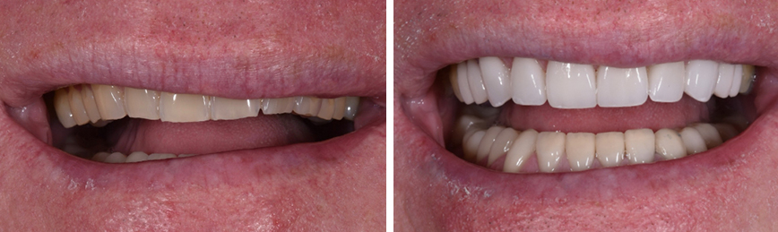 Porcelain Veneers Before After