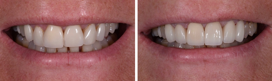 Replacing Old Veneers Before After