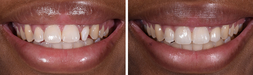 Single Veneer Before After