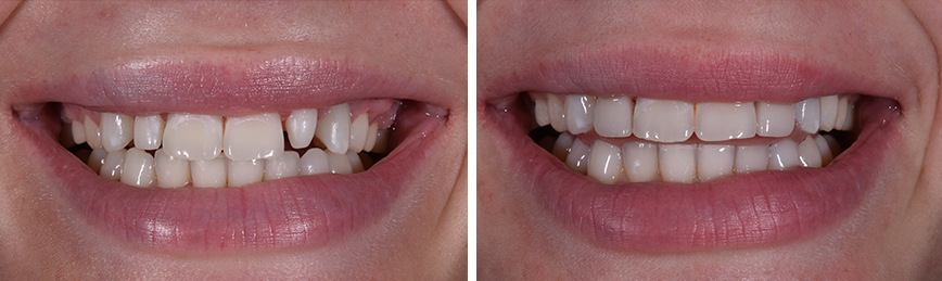 Veneers Ortho Before After
