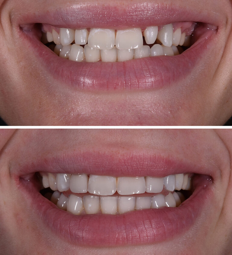 Veneers Ortho Before/After