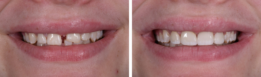 Veneers Before After