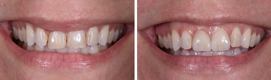 Veneers Before After