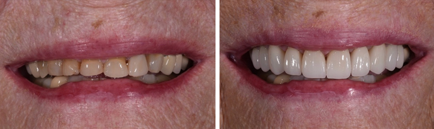 Veneers Before After