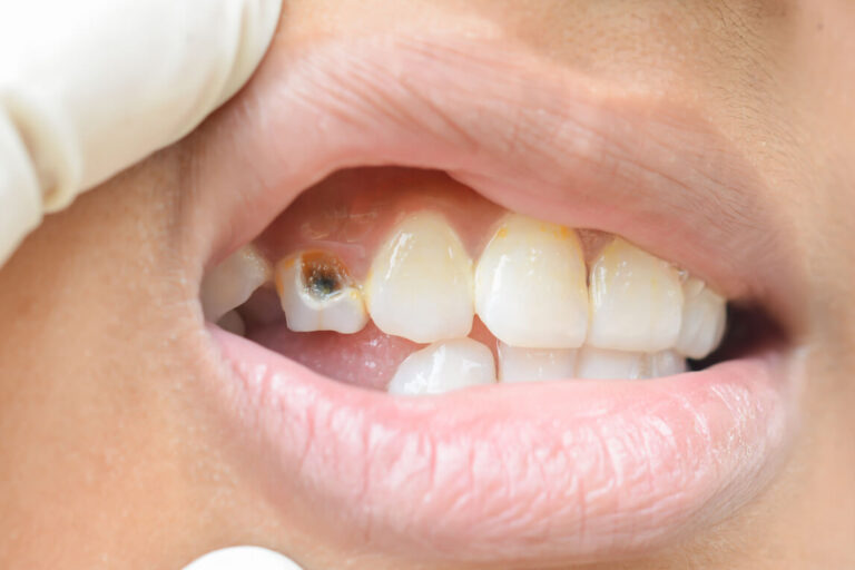 how long can you leave a cavity untreated