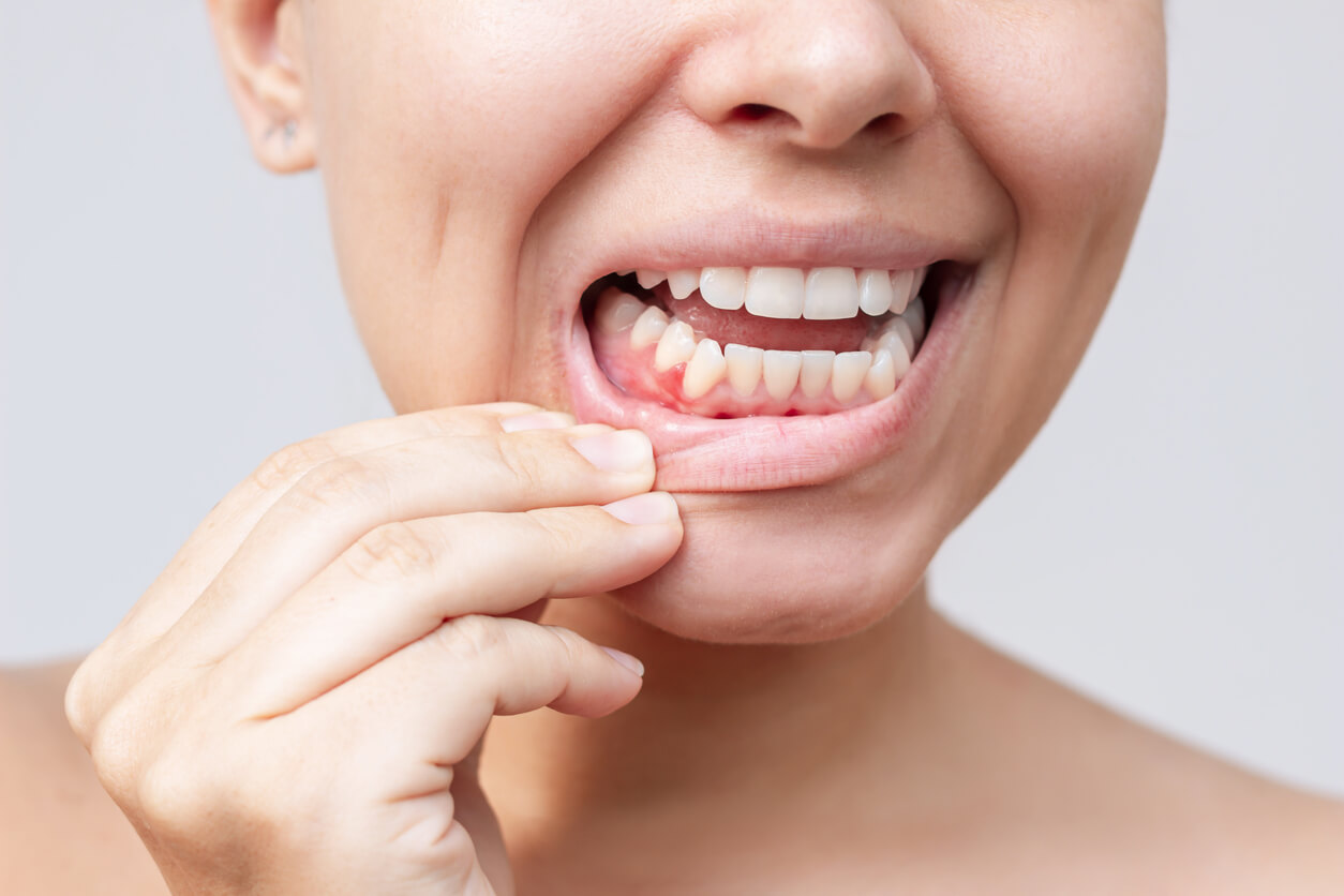 gums why do my gums bleed
