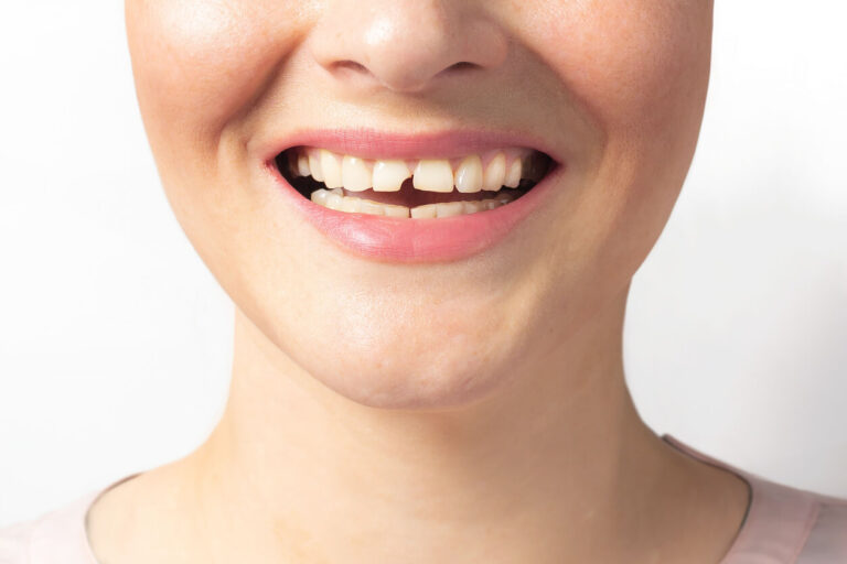 chipped-tooth Woman shows broken tooth.