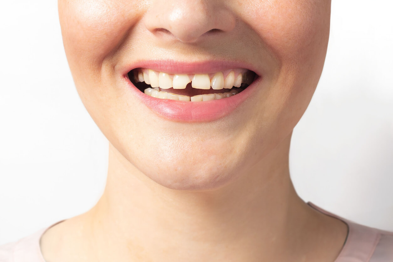 Woman shows broken tooth.