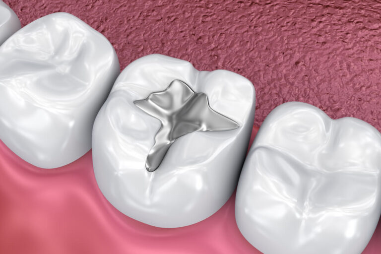 Composite Fillings