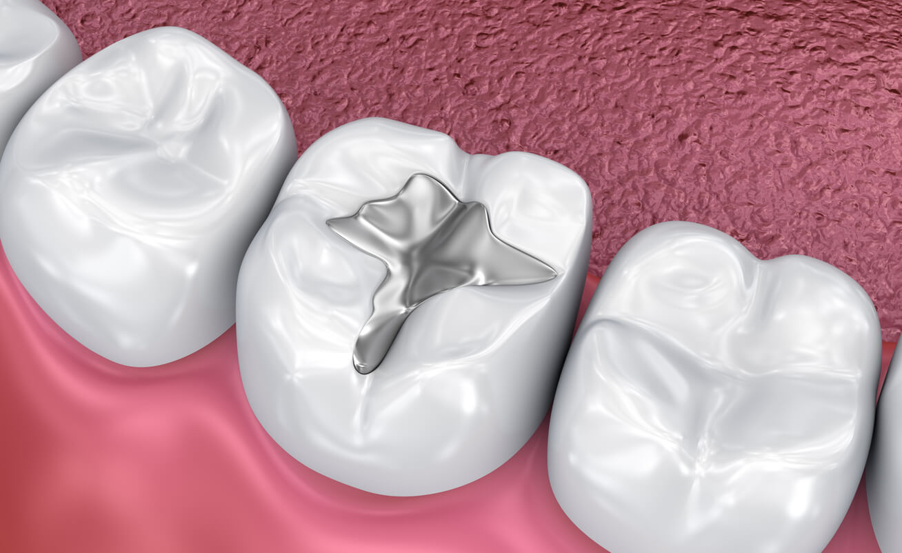 Composite Fillings