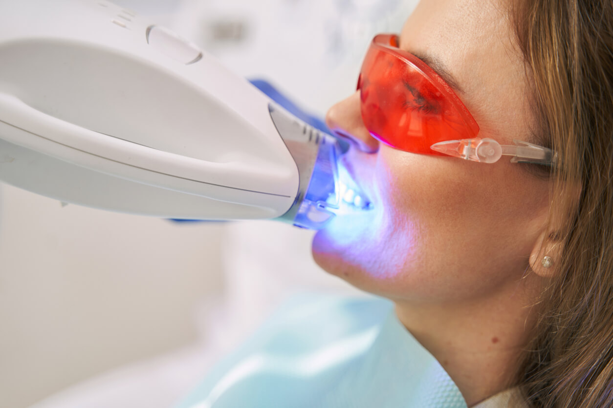 Professional Teeth Whitening