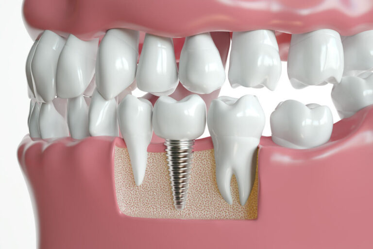 Dental Implants Benefits