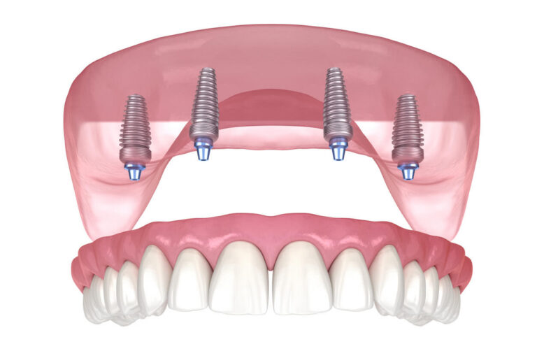what is all on 4 dental implants